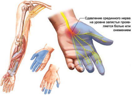 Защемление лучевого нерва в руке: лечение и профилактика