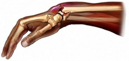Падение на руку приведет к перелому кости