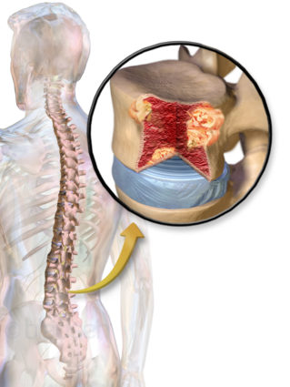 Миеломаляция - это процесс, ведущий к некрозу участков спинного мозга