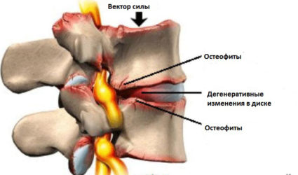 Спондилез - это одна из форм остеоартроза
