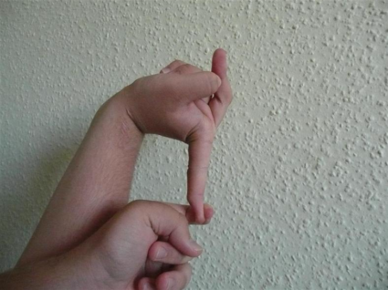  Синдромом Марфана-у людей очень длинные пальцы рук, ног, которые называют «паучьими пальцами»
