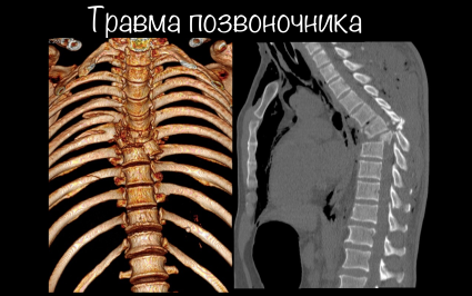 Травма позвоночника на КТ и рентгене