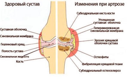 Гонартроз – это заболевание, при котором происходит постепенное истончение и разрушение хряща коленного сустава