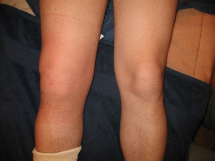 Соответственно существует три степени артрита коленного сустава