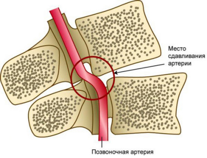 Синдром позвоночной артерии