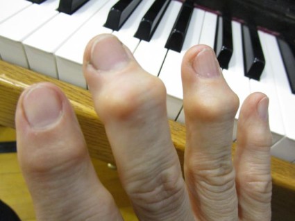Артроз кистей рук поражает небольшие суставы, которые расположены на концах фаланг пальцев