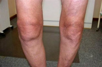 Через определённое время больной замечает признаки деформации колена