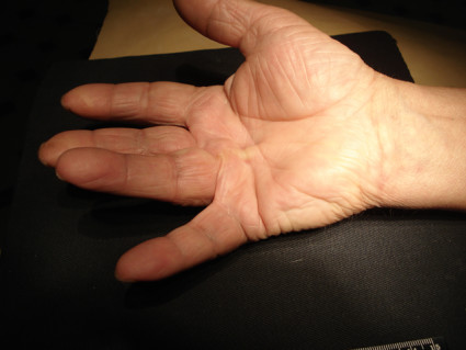 Болезнь Дюпюитрена - тугоподвижность рук,наиболее часто встречается контрактура кисти и пальцев
