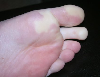 Онемение большого пальца на ноге