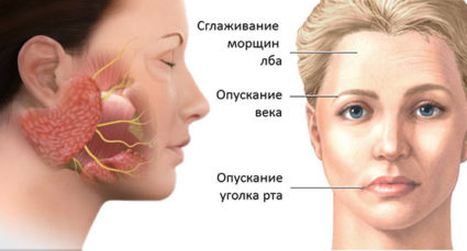 невралгия лицевого нерва