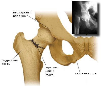 Наиболее частой травмой выступает перелом костей таза