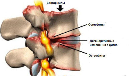 Остеофиты придавливают корешки нервов спинного мозга и вызывают ишиас
