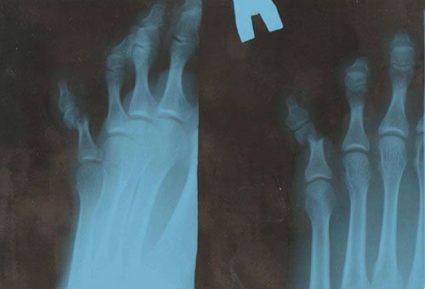 Рентген после травм пальца на ноге