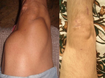 Основным признаком такой болезни, как гемартроз коленного сустава, является кровоизлияние