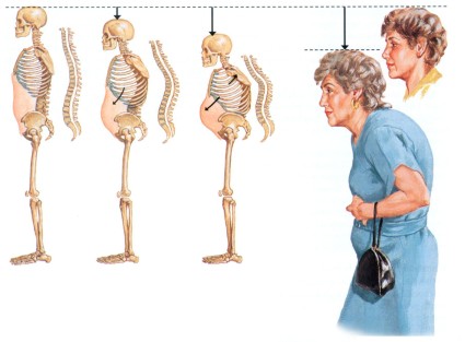 Признаки остеопороза - человек растет вниз