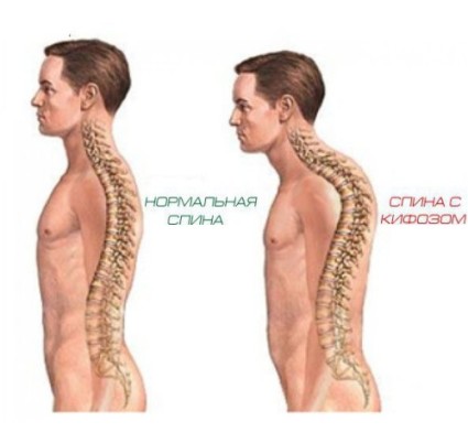Нормальная спина и спина с кифозом