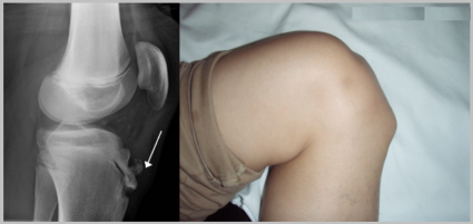 Рентген коленного сустава не идеален, но вот з патологию можно уже на нем
