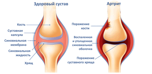 Здоровый коленный сустав и сустав поражённый артритом