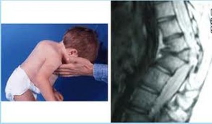 Кифоз у детей - довольно частые явления, которые образовываются из-за недостаточно крепкой мускулатуры спины