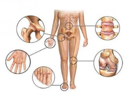 Артритом могут быть повреждены несколько суставов одновременно