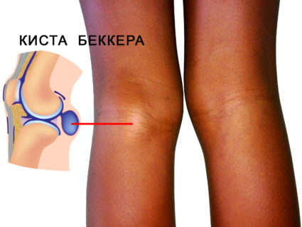 Опухоль сзади либо спереди коленного сустава - киста Беккера
