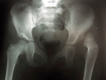 Рентген при вывихе тазобедренного сустава