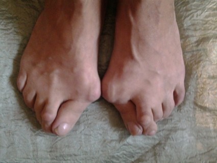 Нередки поражения пальцев ног