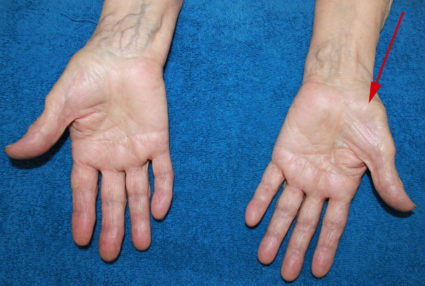 Симптомы СКК - немота пальцев рук