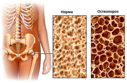 Нормальная кость и кость, подверженная остеопорозом