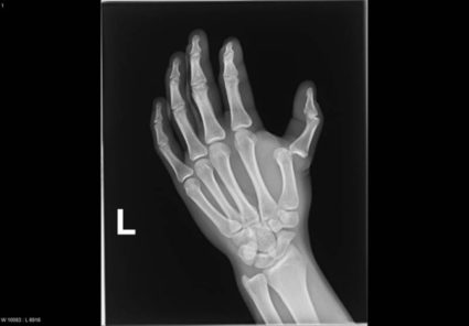 Установить точный диагноз можно с помощью проведения рентгенографии
