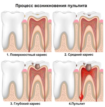 Воспаление зуба 