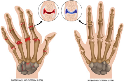Артроз кистей рук - это суставная болезнь