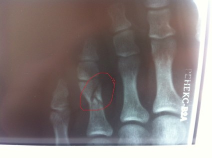 Перелом пальца на рентгене