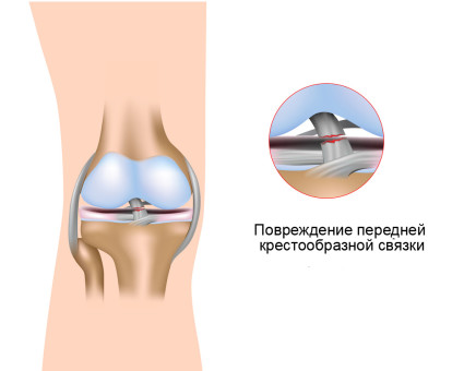 Главной причиной болезни врачи называют травмы колена