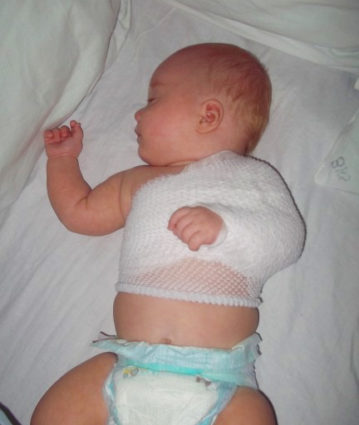 К сожалению, такая травма часто встречается у новорожденных и у детей до 1 года