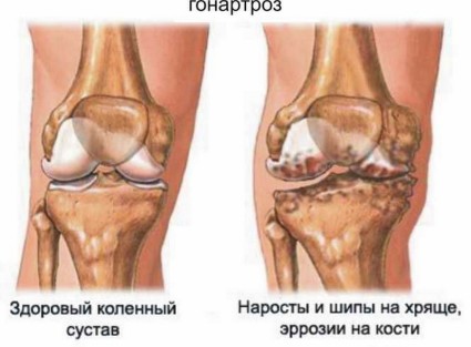Заболевание коленного сустава, при котором происходит разрушение суставного хряща