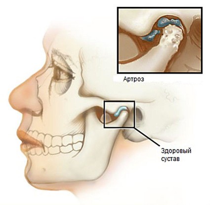 Артроз суставов челюсти