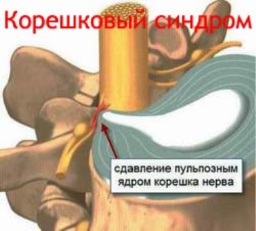 Корешковый синдром - острый приступ боли, распространяющийся вдоль пораженного нерва