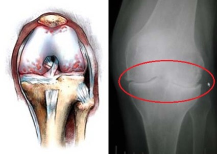 Гонартроз – это заболевание сустава колена