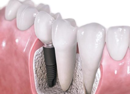 Имплантация зуба 