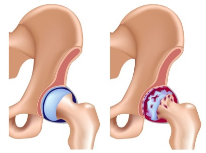 Очень часто дисплазия соединительной ткани тазобедренного сустава приводит к развитию диспластического коксартроза