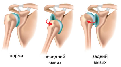 Вывихи плеча различаются в зависимости от причины и частоты получения травмы