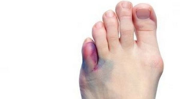 Травма пальца на ноге