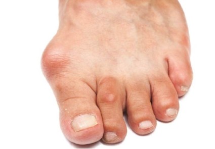 Артроз пальцев ног по своей симптоматике и способам лечения весьма схож с артрозом фаланг рук