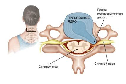 Основные причины грыжи диска шейного отдела кроются в патологических изменениях в позвоночнике