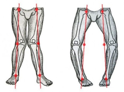 Гонартроз 3 степени может проявляться в виде Х-образной либо же О-образной деформации коленного сустава