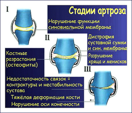 Остеоартроз колена 2 стадии может привести к опухоли