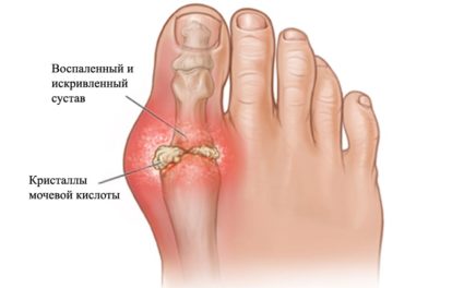Артрит сустава пальца ноги