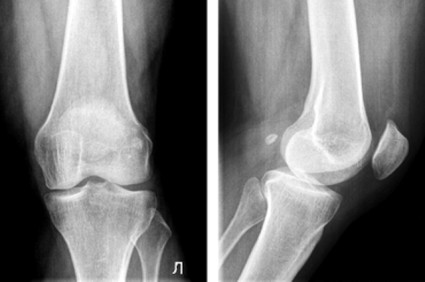 Рентгенография деформирующего артроза коленного сустава