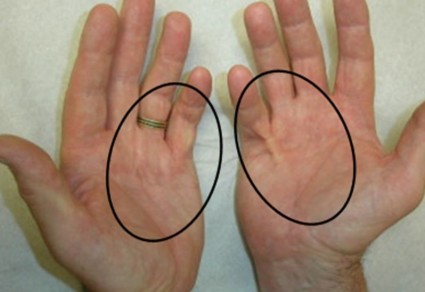  Контрактура суставов рук связана с ограничением их подвижности